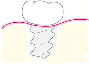 implantes-dentales