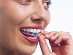 invisalign